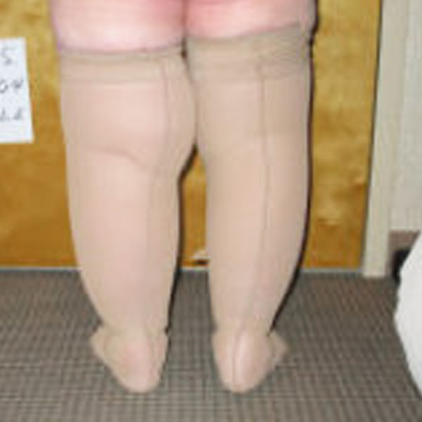 Leg Lymphedema Compression Garments